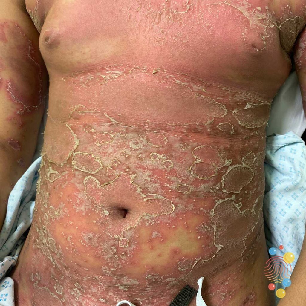 Pustular psoriasis