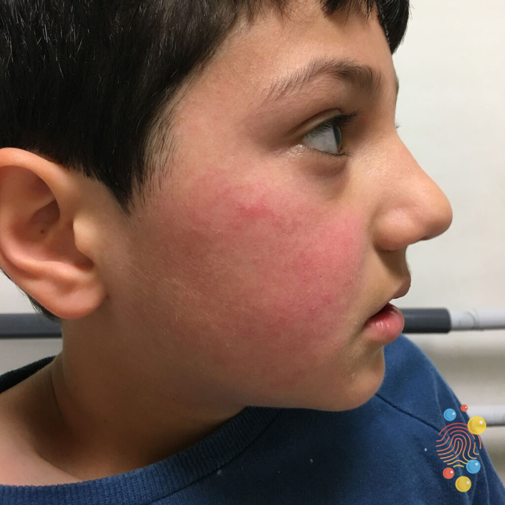 Allergic contact dermatitis