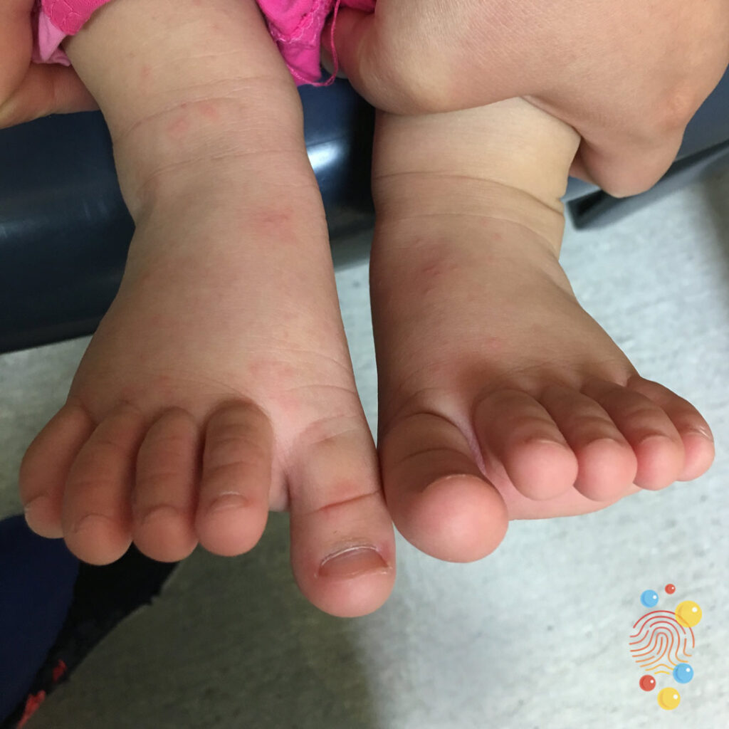 Hand, foot & mouth