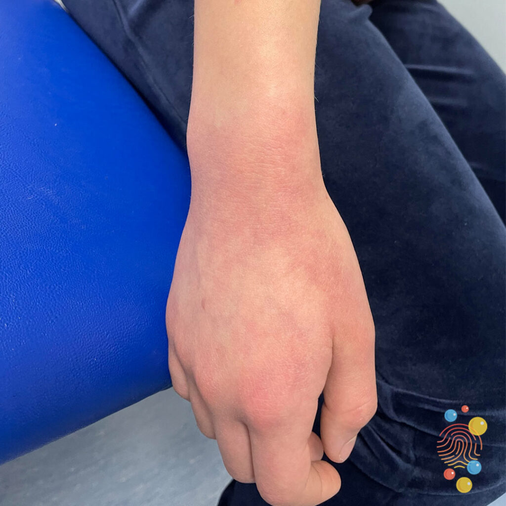 Eczema