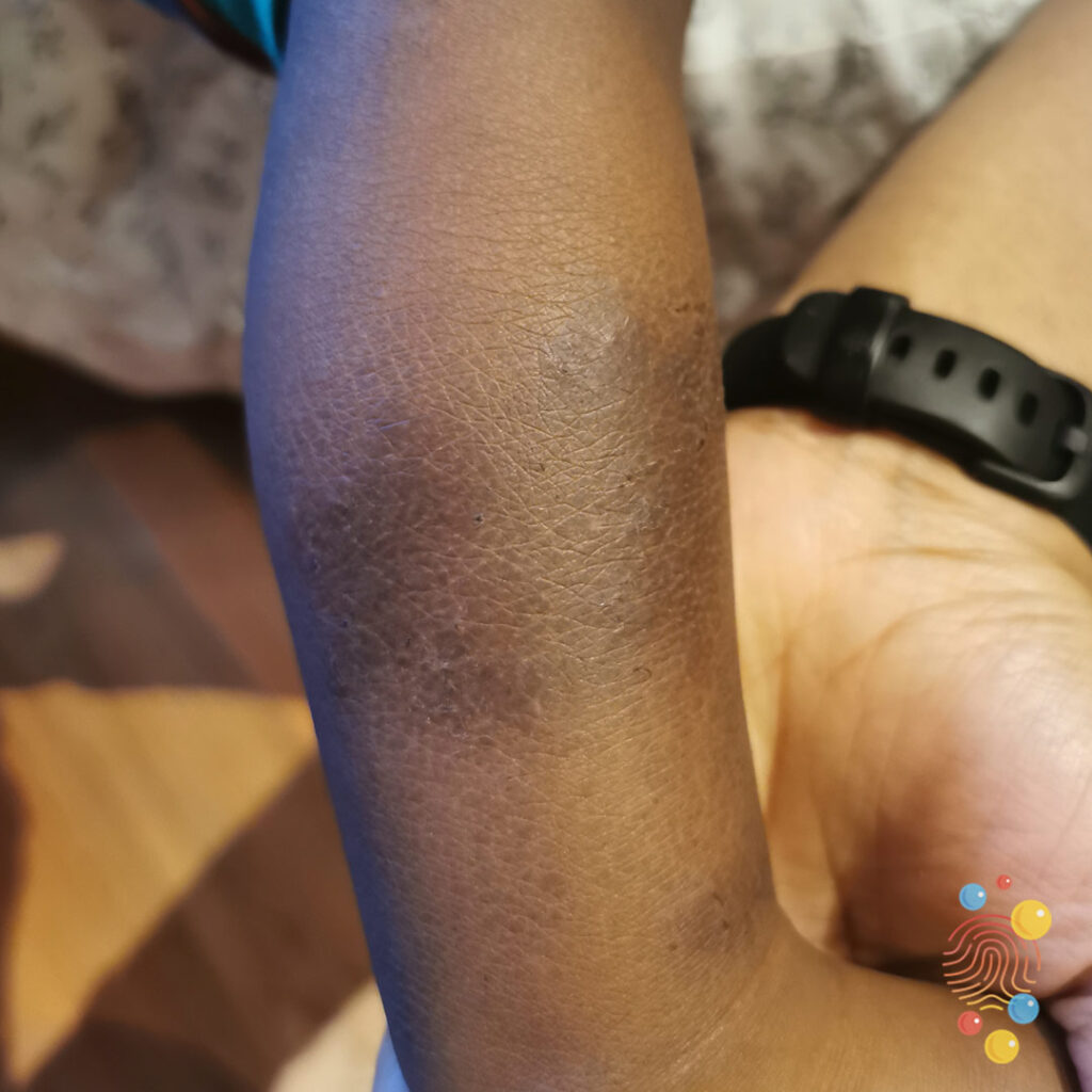 Discoid eczema