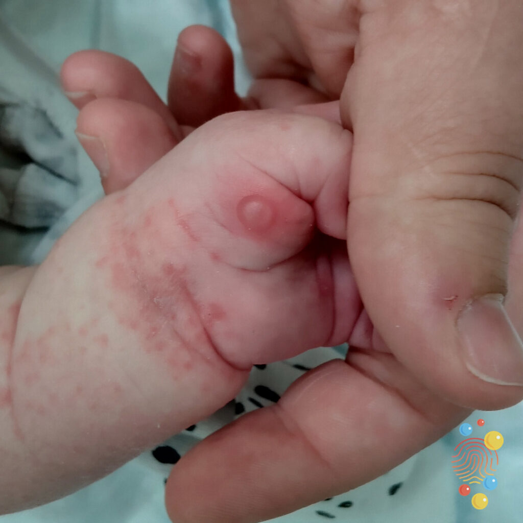 Eczema Coxsackium