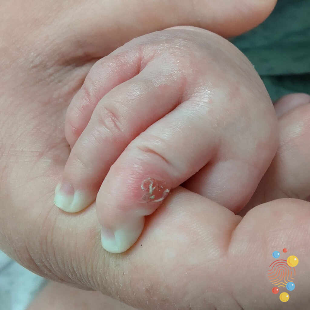 Eczema Coxsackium