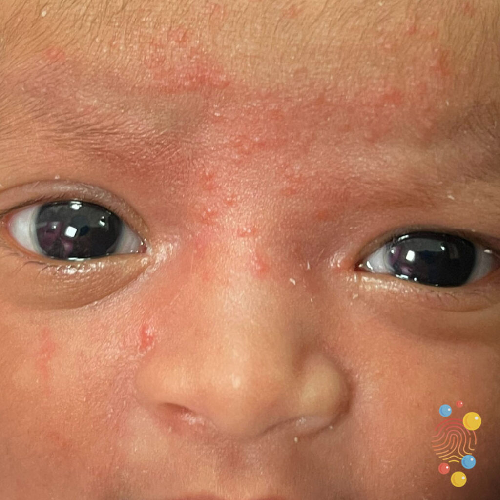 Erythema Toxicum
