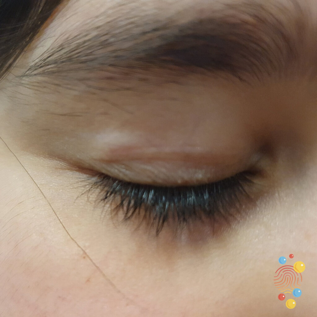 Chalazion
