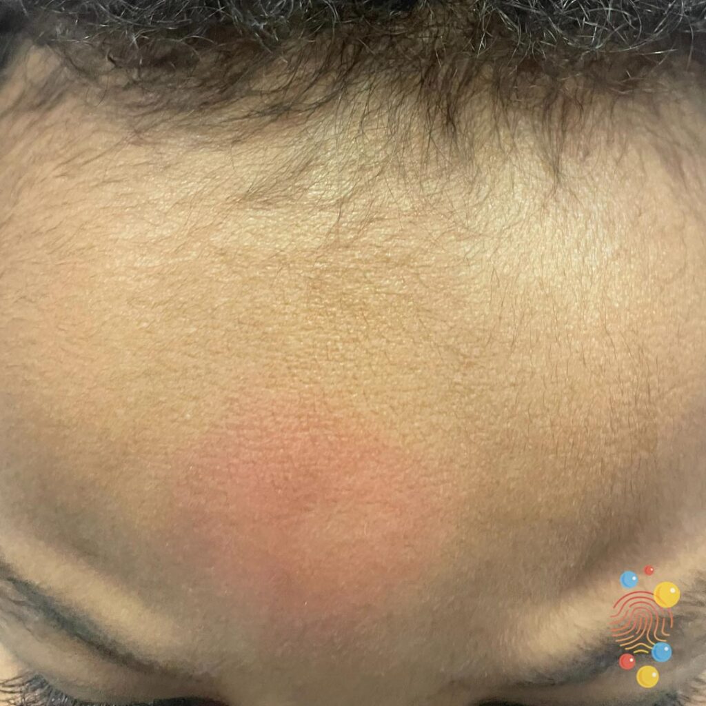 Bruise