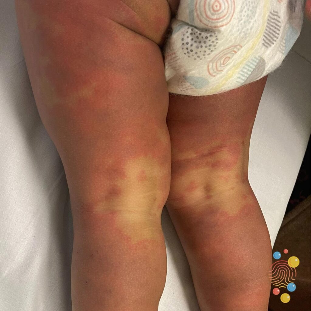 Urticarial Vasculitis