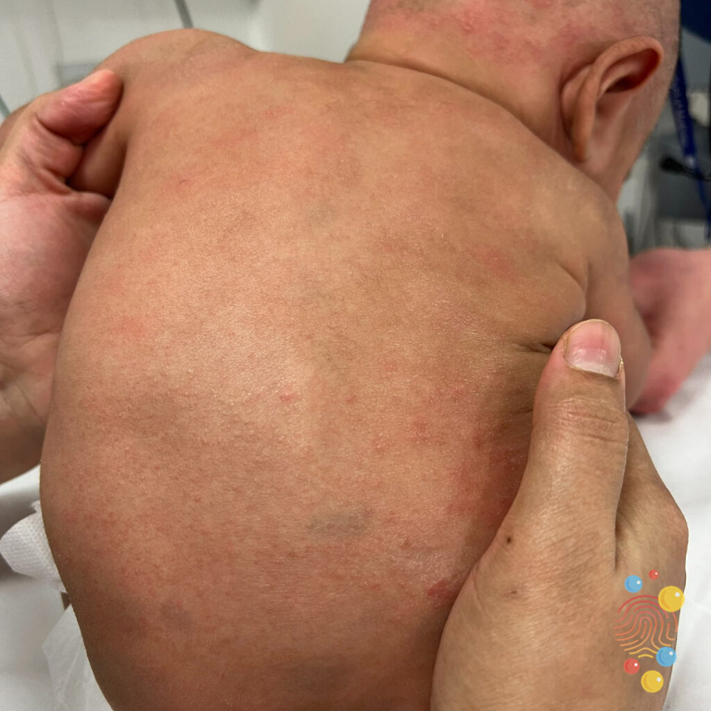 Eczema plus haemangioma and dermal melanocytosis