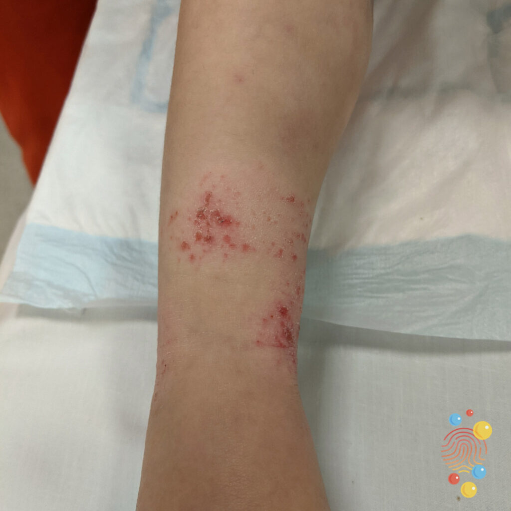 Eczema Herpeticum