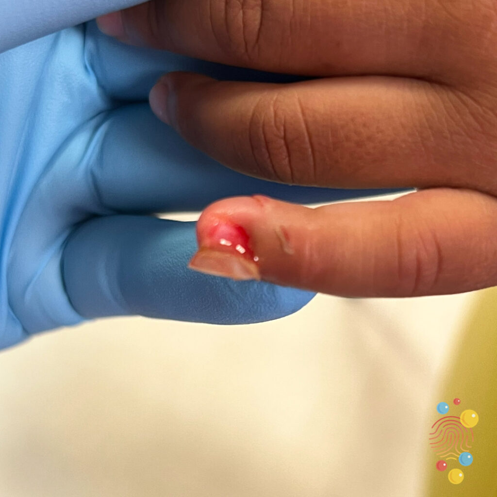 Avulsed Nail
