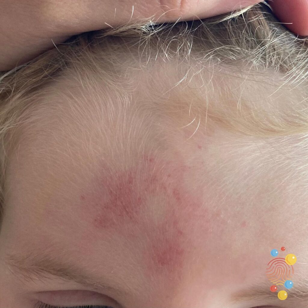 Head Injury
