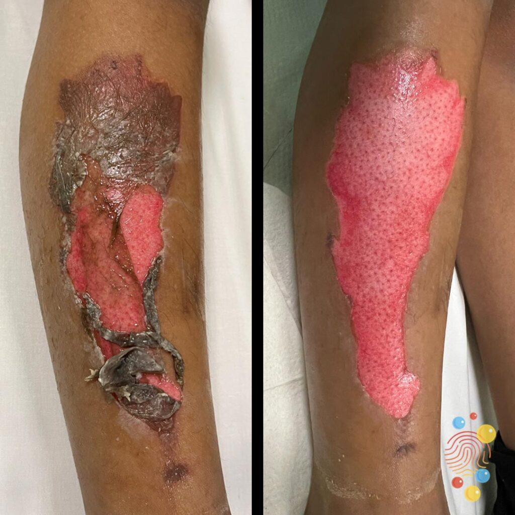 Burn - Pre & Post Deroofing