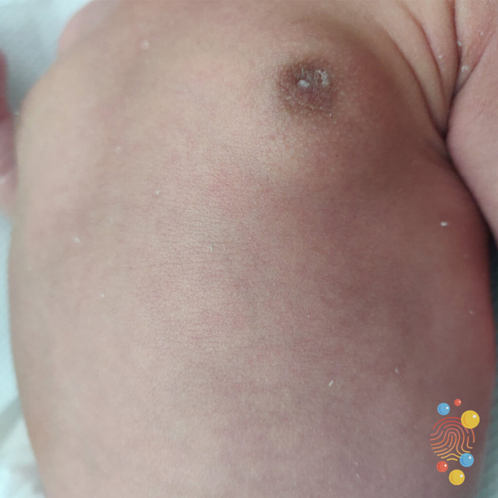 Gynaecomastia