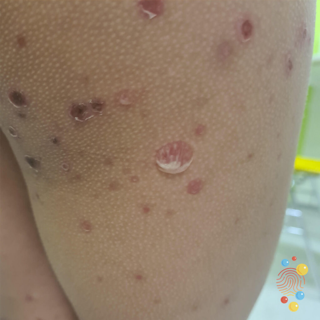 Bullous Impetigo