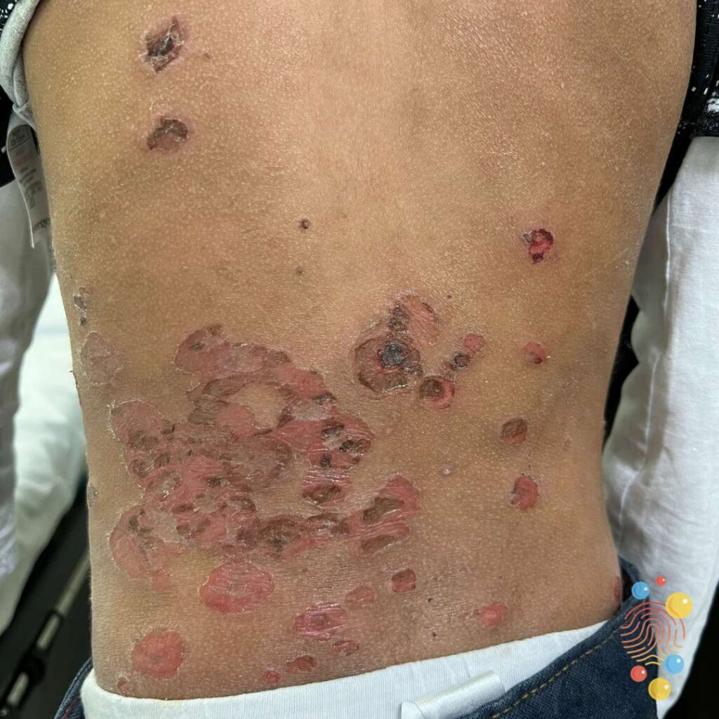 Bullous Impetigo