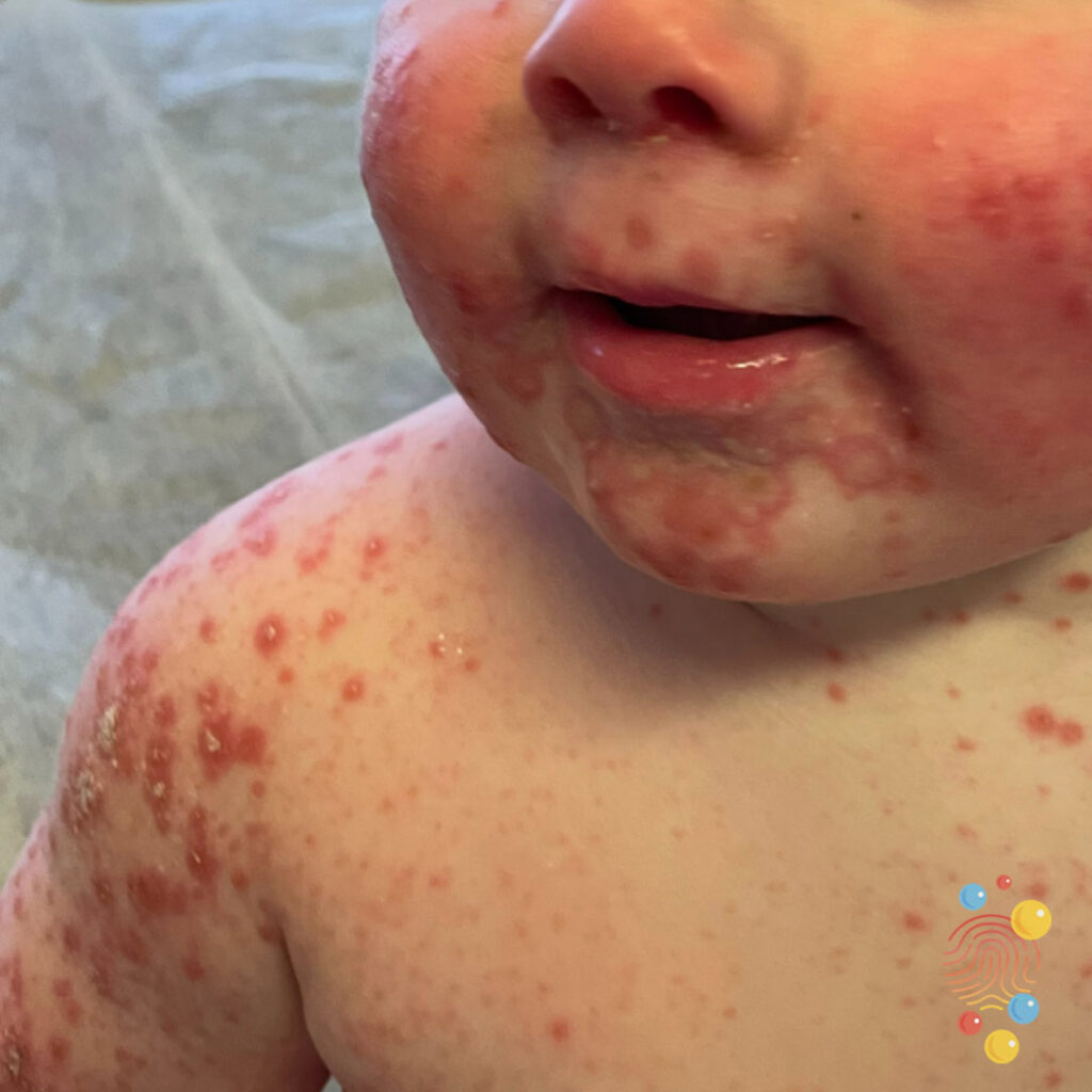 Eczema Coxsackium