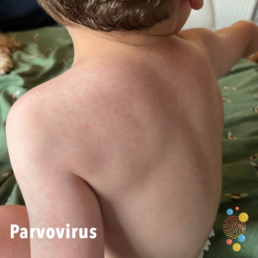 Parvovirus