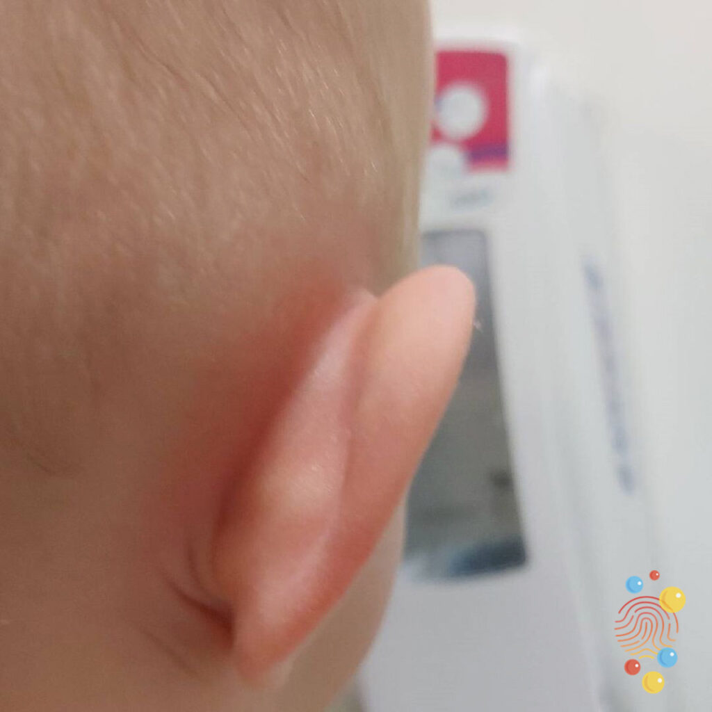 Mastoiditis