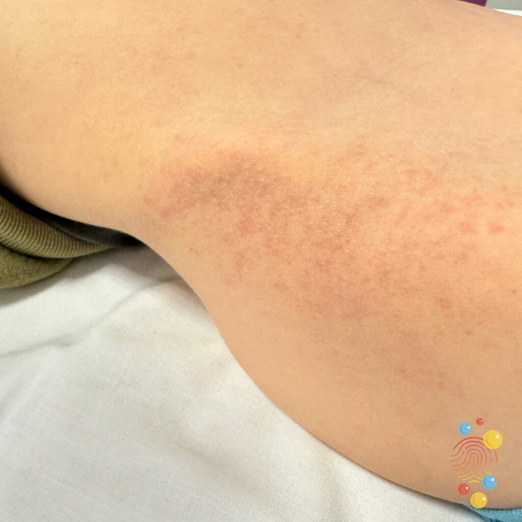 Petechial rash