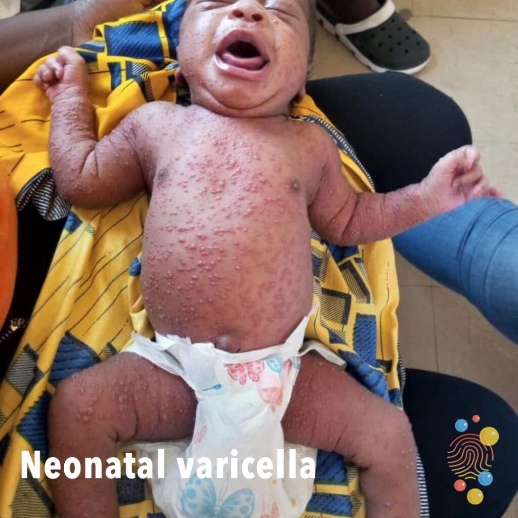 Neonatal Varicella